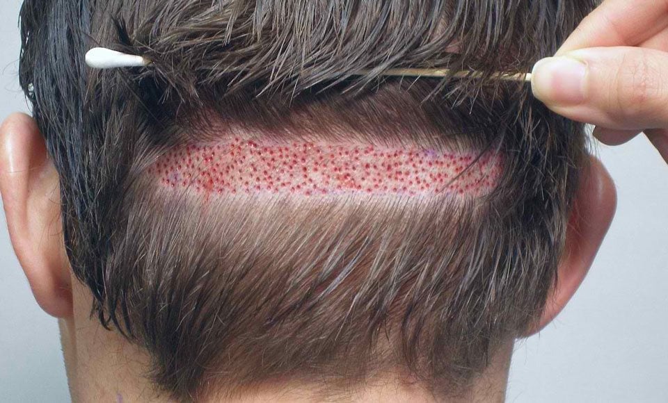 Hair Transplants Growing Your Hair Back With Modern Procedures
