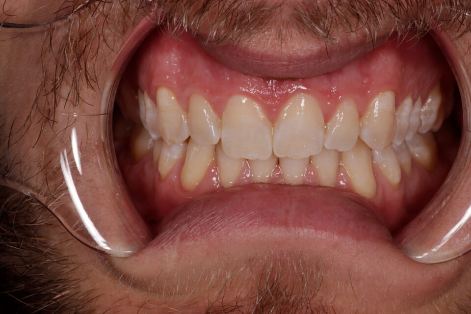 hismile-review-from-someone-with-very-bad-teeth