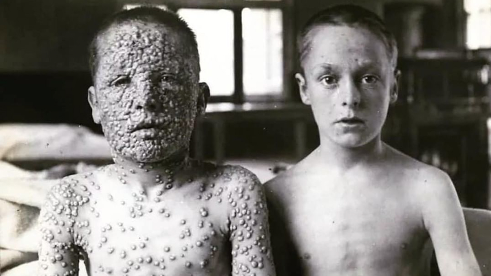 Shocking Smallpox Photo Shows The Benefits Of Vaccination