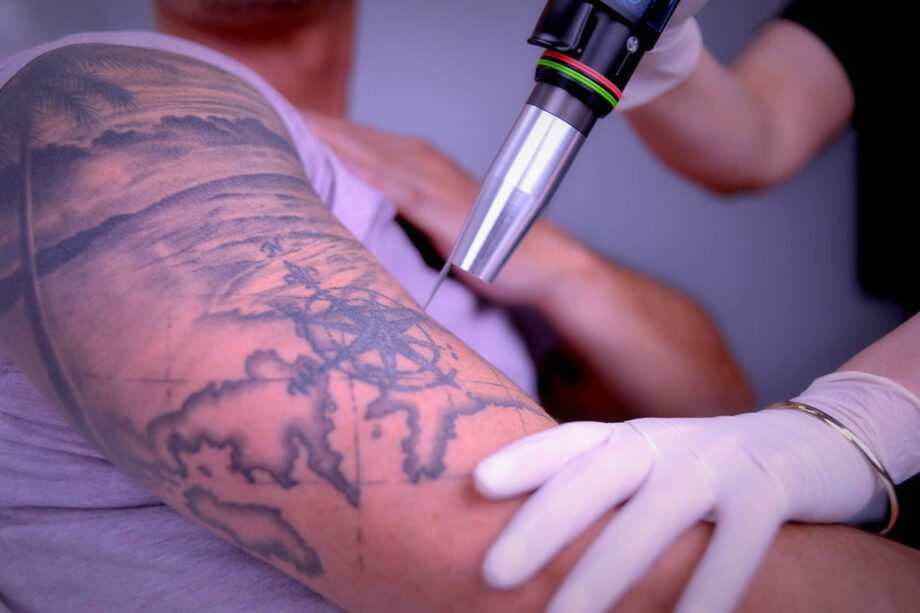 6 Best Tattoo Removal Clinics In Sydney DMARGE