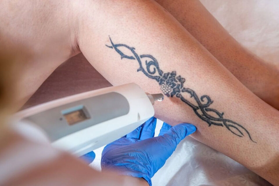 6 Best Tattoo Removal Clinics In Sydney DMARGE