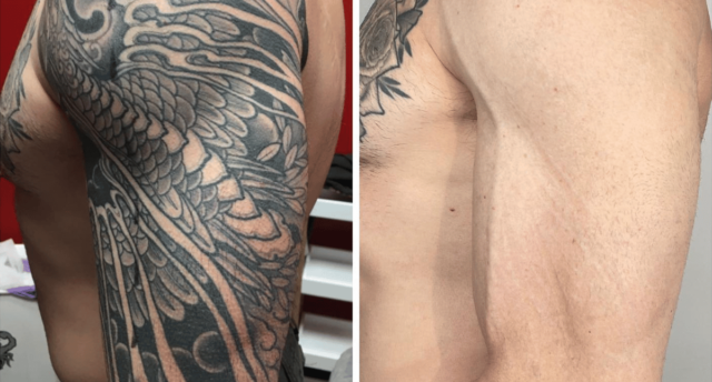 Laser Tattoo Removal Source @swlasertattooremoval via Instagram