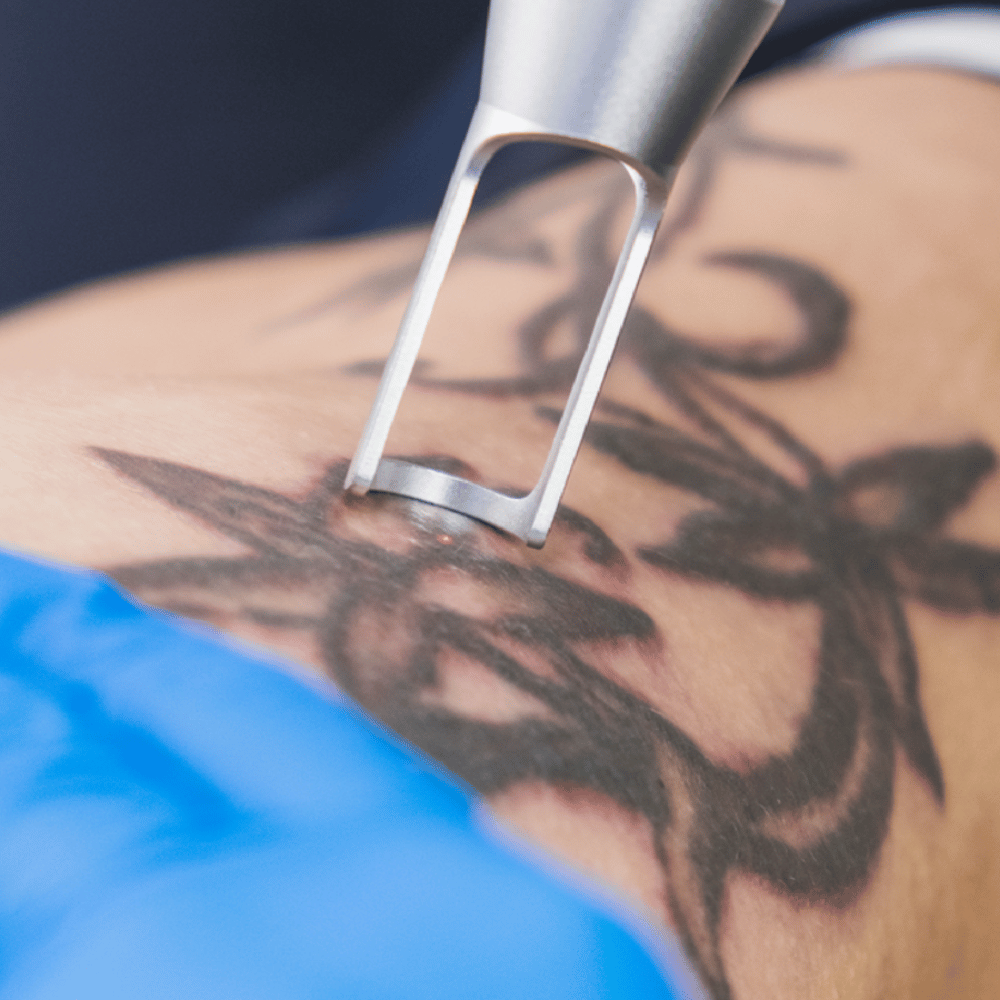 How Does Laser Tattoo Removal Work DMARGE