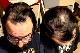 Balding Redditor’s Insane Glow-Up Will Make You Want To Shave Your Head