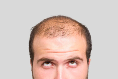 Scientists Reveal The Only Guaranteed Way To Never Go Bald, But You Won’t Like It