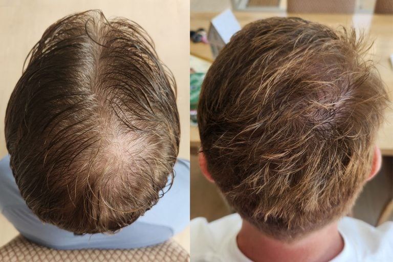 The Hairy Pill Review The AllInOne Hair Loss Treatment With Surprising Results DMARGE